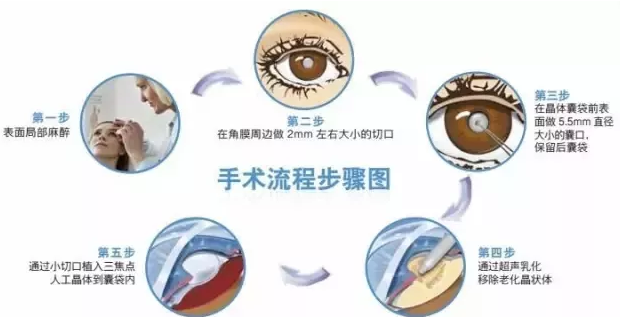 12月23日，普瑞眼科白內(nèi)障患者答謝會(huì)邀您參加!